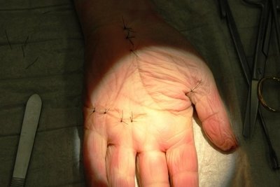 Hand mit Operationsnarben