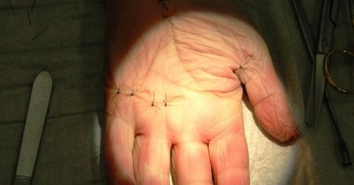 Hand mit Operationsnarben